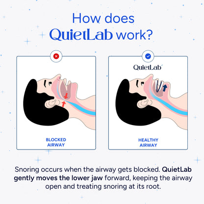 QuietLab Pro® Anti-Snoring Mouthpiece